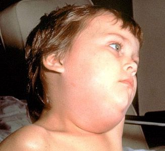 mumps_symptoms1