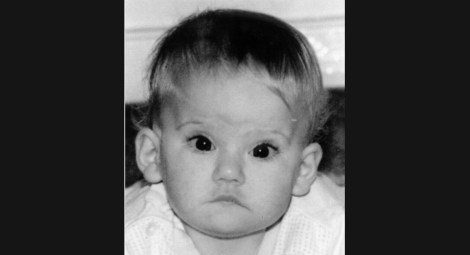 Smith-Magenis-Syndrome-Picture