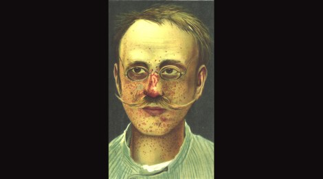 TuberousSclerosis-Kothe