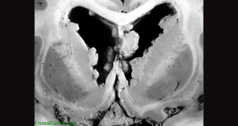 gliageek_TuberousSclerosis_SEGAandNodules