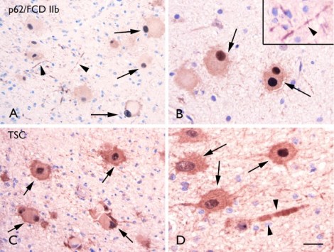 Figure-8-62-immunoreactivity-A-B-Focal-cortical-dysplasia-FCD-IIb-with-p62.png