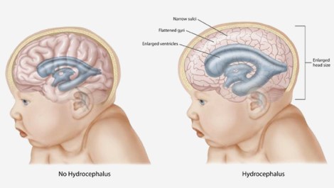 Hydrocephalus-In-Infants
