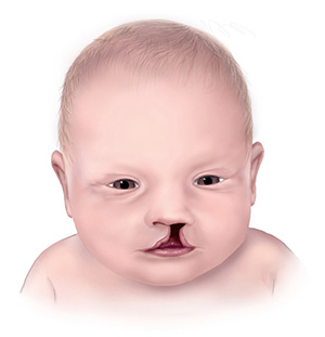 baby-with-cleft-lip